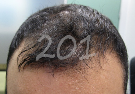 ashley-and-martin-hair-loss-201