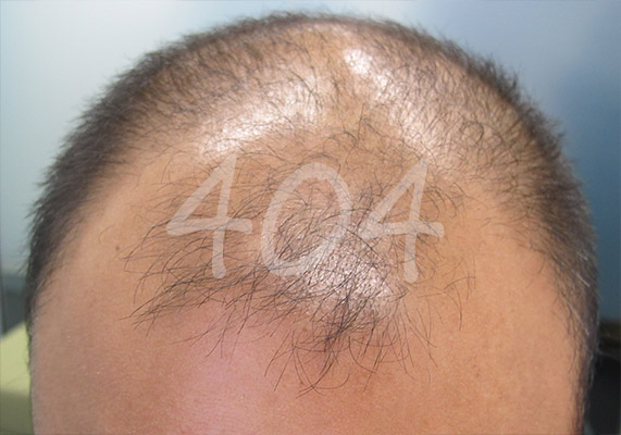 ashley-and-martin-hair-loss-404
