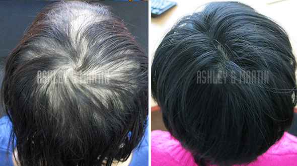 Ashley and Martin Hair Loss for Women