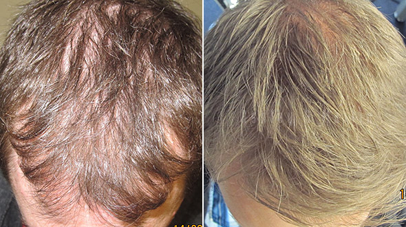 Hair Density Doubled with Ashley and Martin RealGROWTH Program | Ashley and  Martin