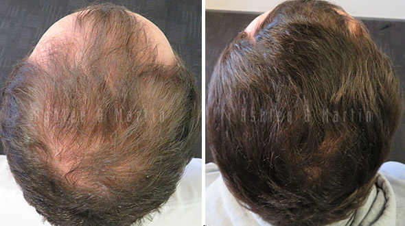 Case Study: Client's scepticism alleviated after seeing his own before and  after hair loss photos | Ashley and Martin