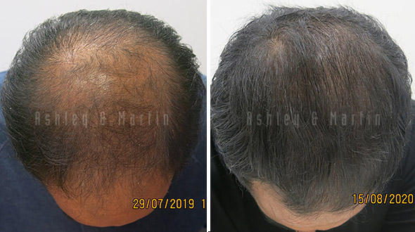 Treatment for steroid related hair loss