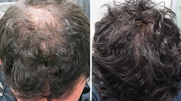 Results of a hair loss treatment for male pattern baldness