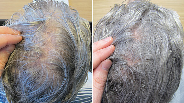 Hair loss treatment for senior