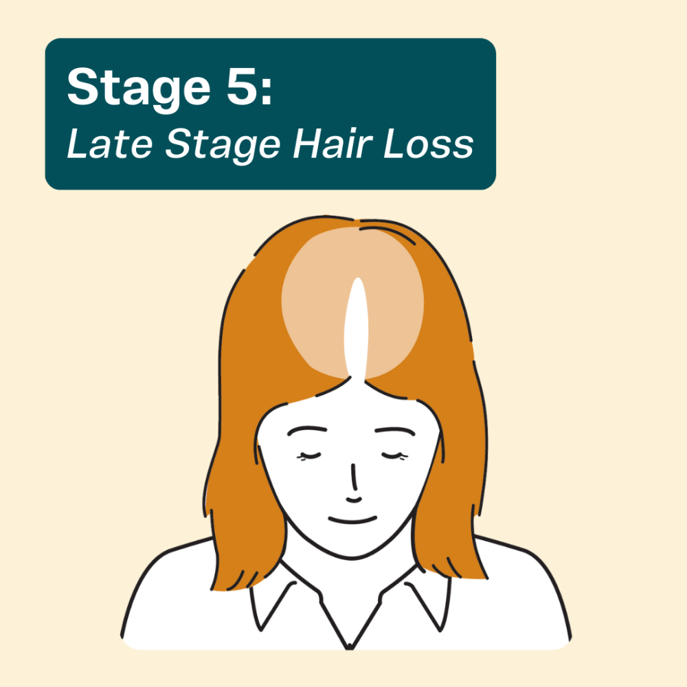 Hair thinning in females at Stage 5