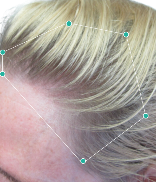 Womens hair loss treatment before