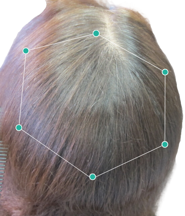 Recovery from Stage 4 hair loss using a laser cap