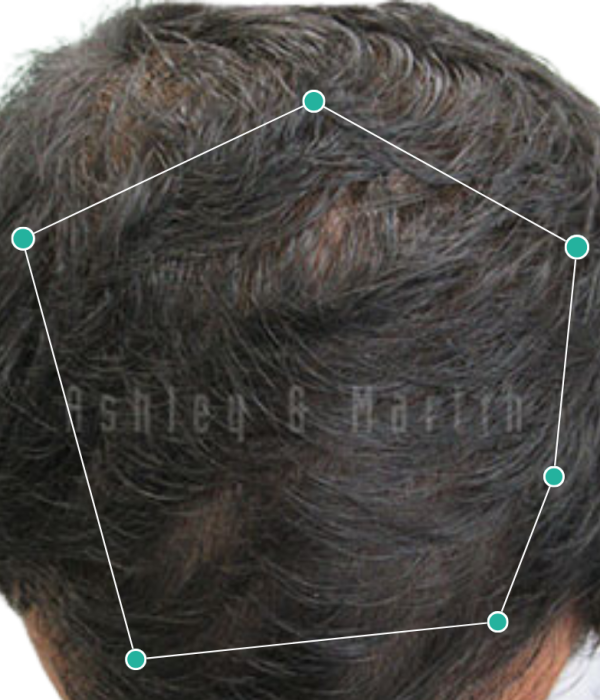 Natural hair loss treatment after