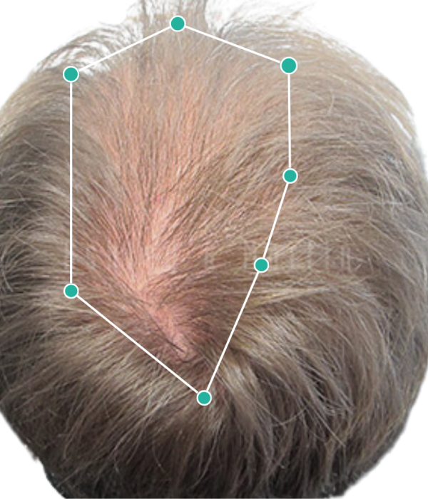 Results of hair loss treatment for older men