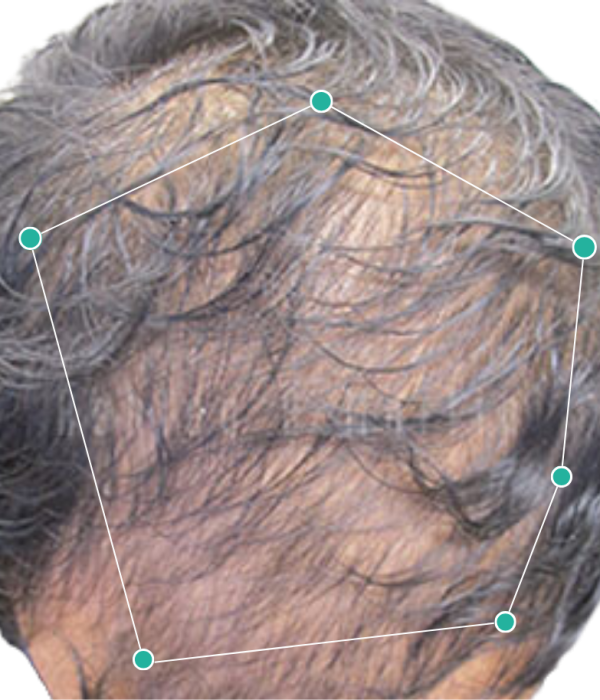 Natural hair loss treatment before